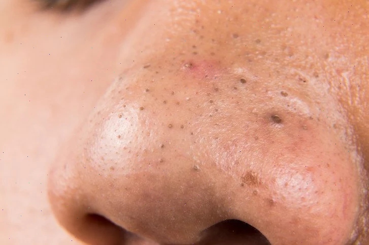 Откуда берутся эти черные точки и белые бугорки?