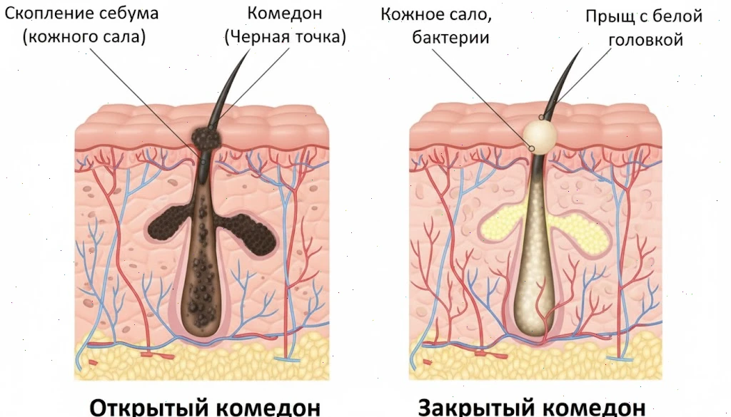 Что такое закрытые комедоны?